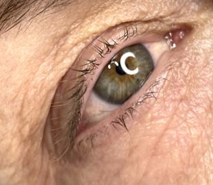 Vor der Behandlung Vor der Behandlung